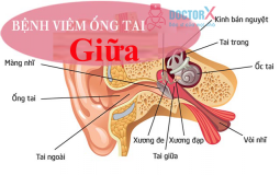 chua-viem-ong-tai-giua